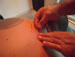 Acupuncture